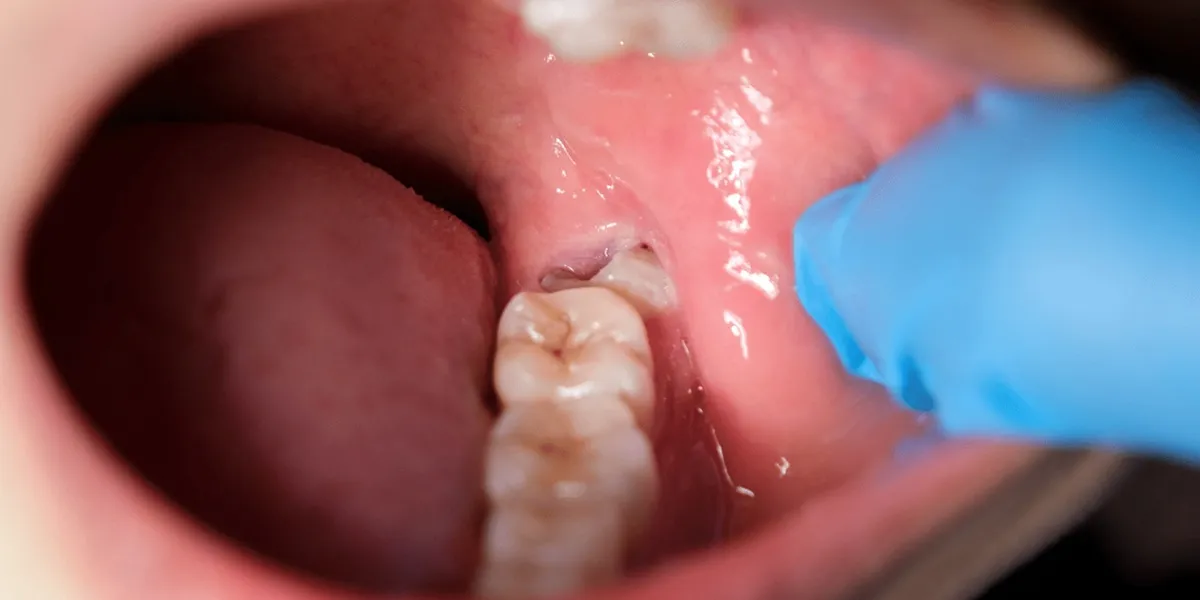 کشیدن دندان عقل