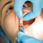 برای بیماران قلبی کشیدن دندان عقل بالا راحت تره یا پایین؟