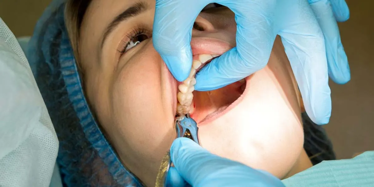 کشیدن دندان عقل